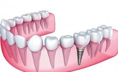 上海种植牙价格一般一颗多少钱？附种植牙操作方式科普